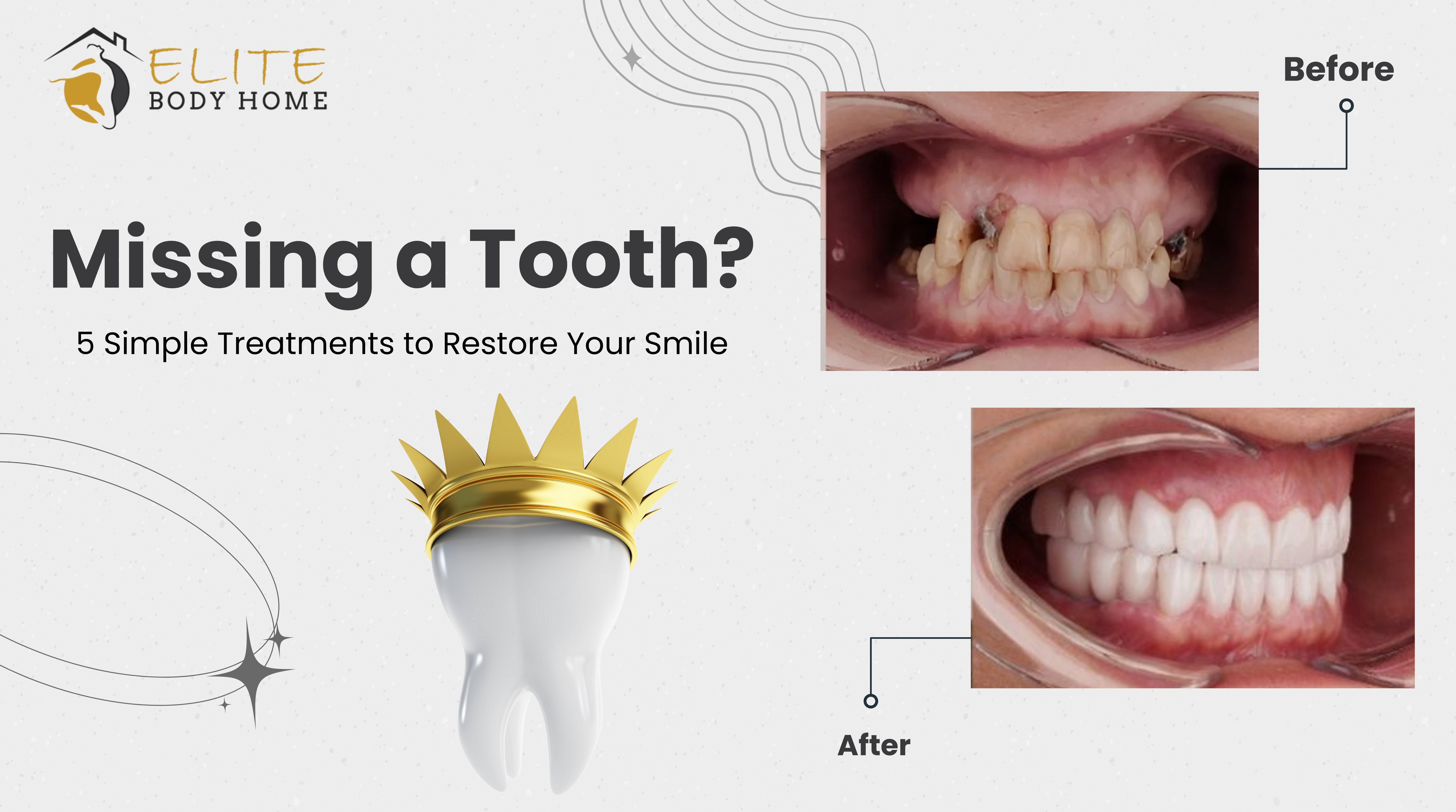 Missing a Tooth? 5 Simple Treatments to Restore Your Smile 