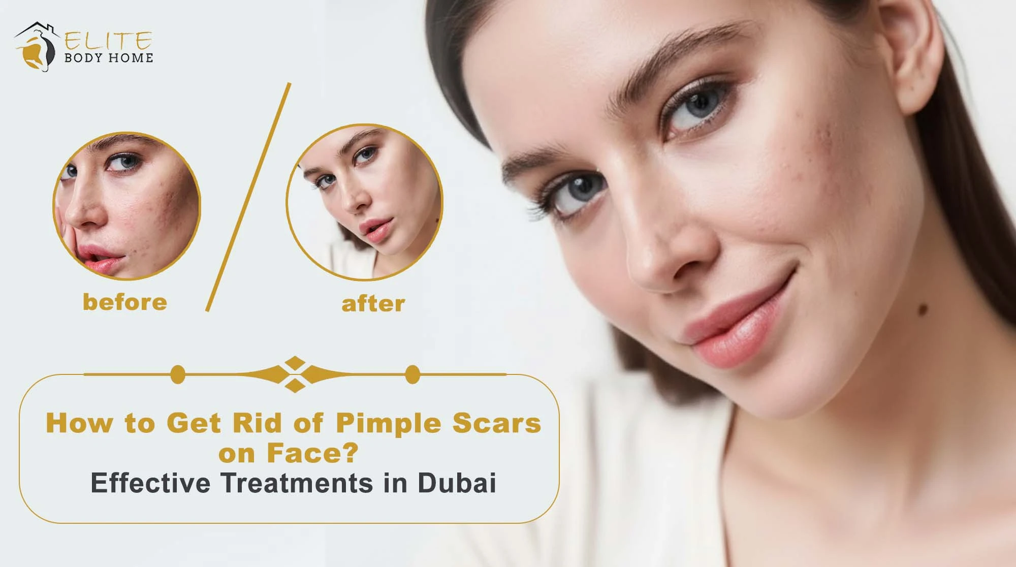 How to Get Rid of Pimple Scars on Face? Effective Treatments in Dubai