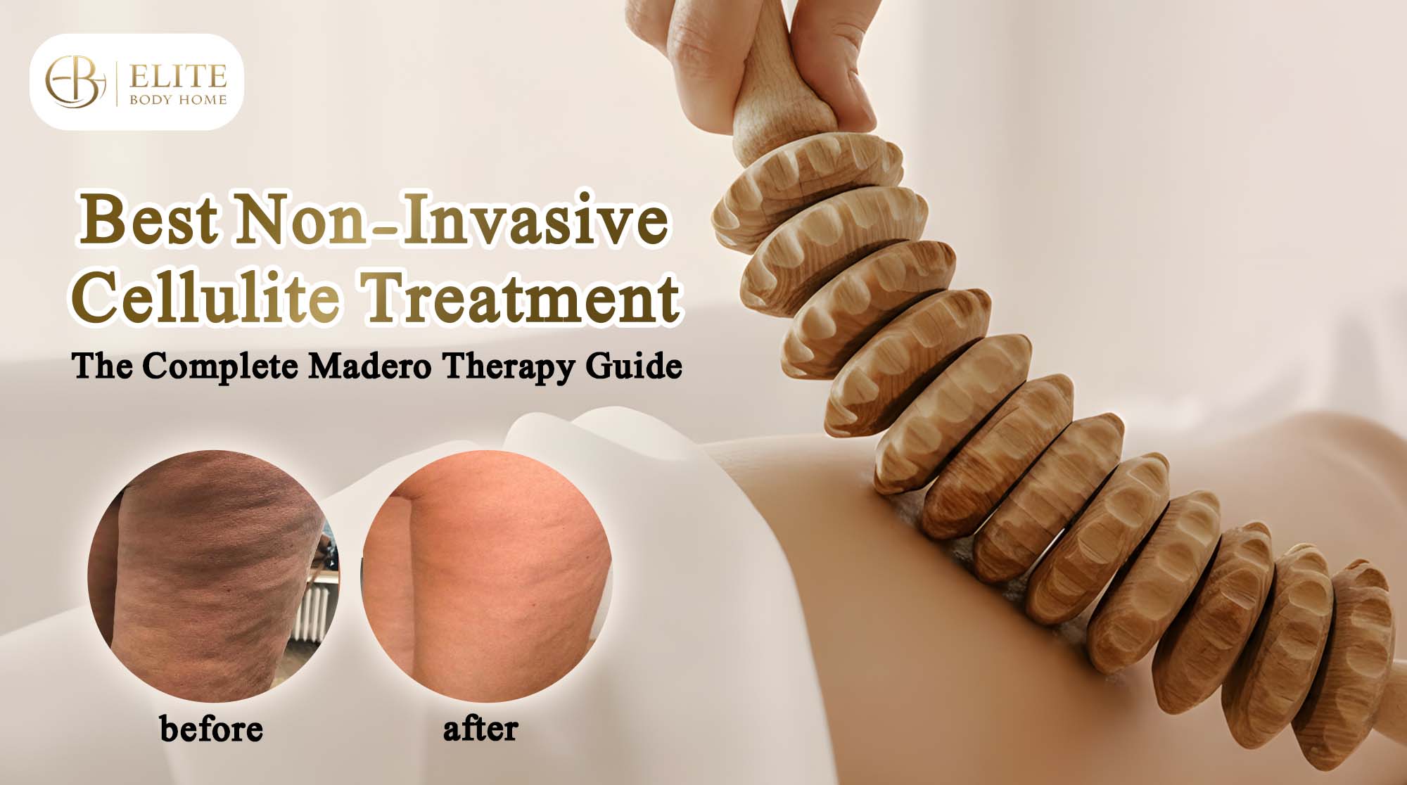 Best Non-Invasive Cellulite Treatment: The Complete Madero Therapy Guide
