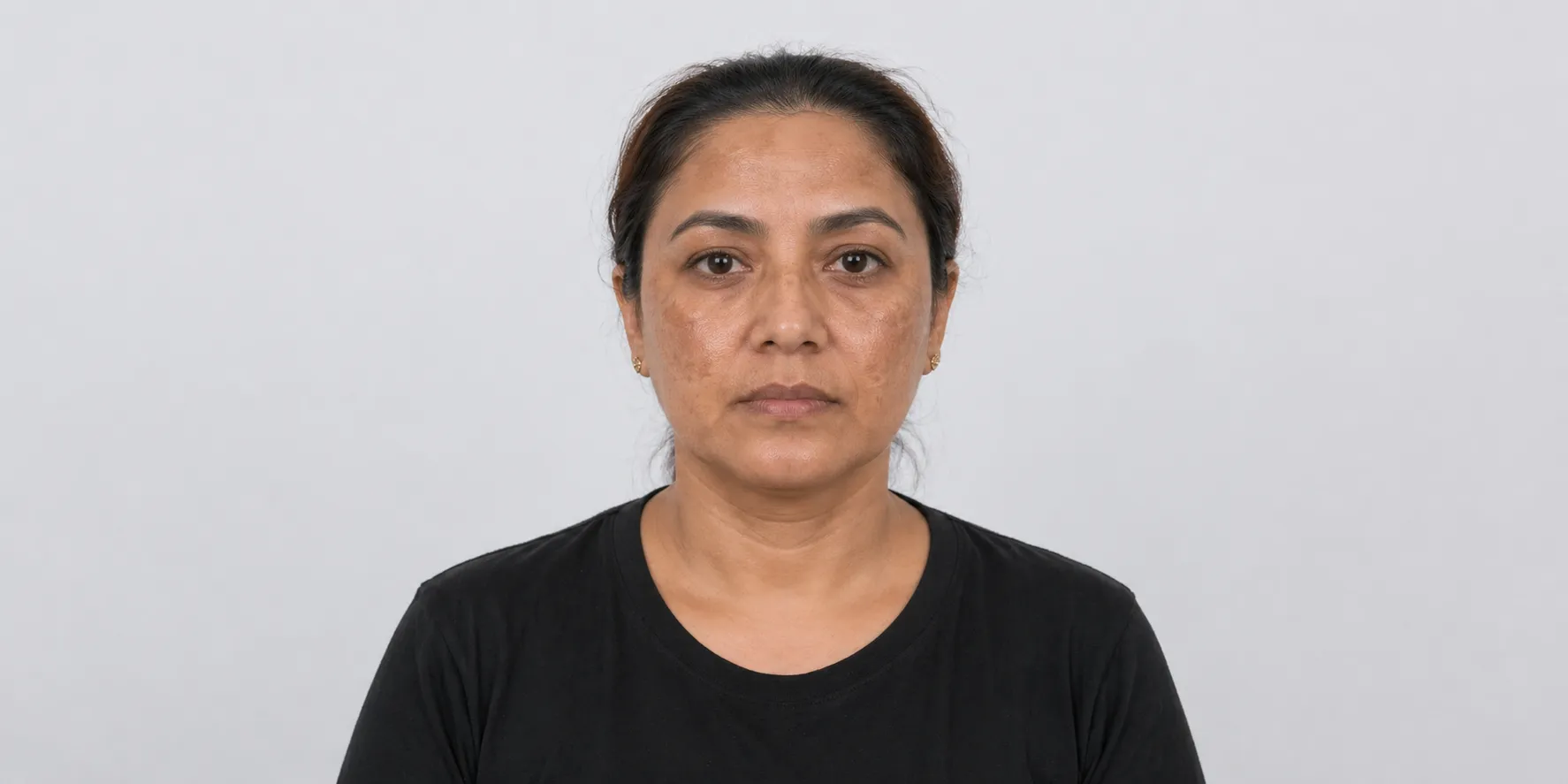 melasma-Face