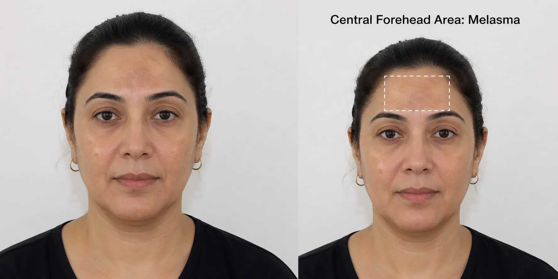 melasma-Forehead