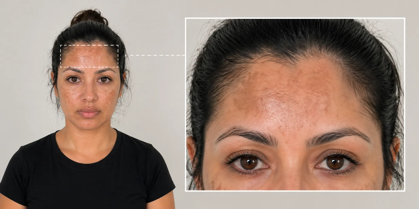 hyperpigmentation-Forehead