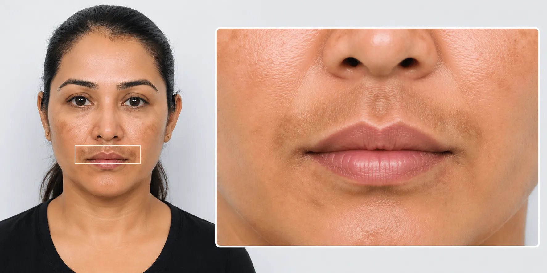 hyperpigmentation-Upper-Lip-Area
