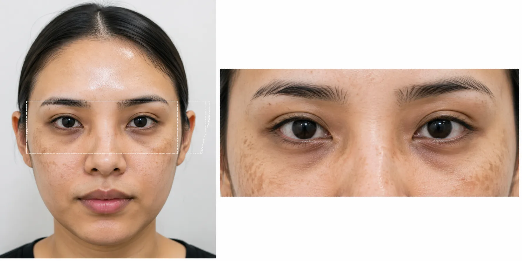 hyperpigmentation-Periorbital-Area