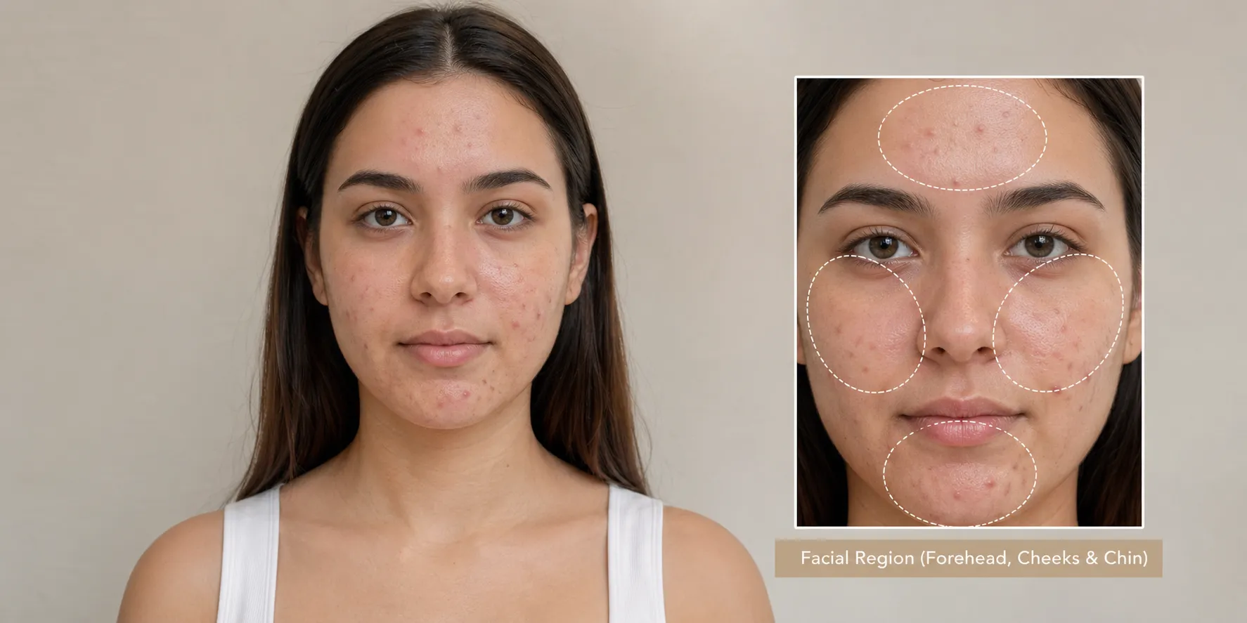 acne-Facial Region