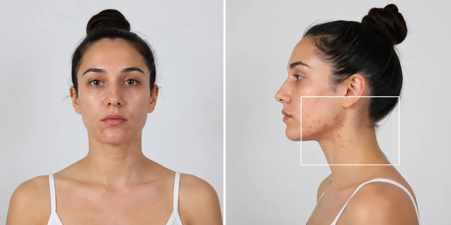 acne-Jawline-Neck