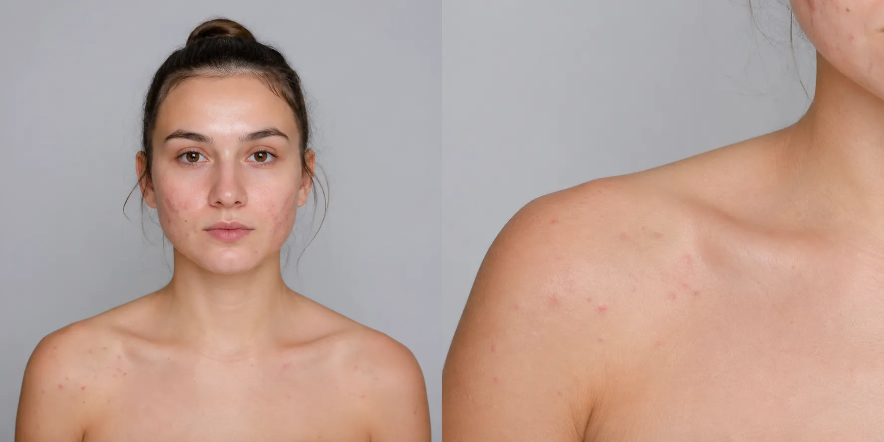 acne-Shoulders
