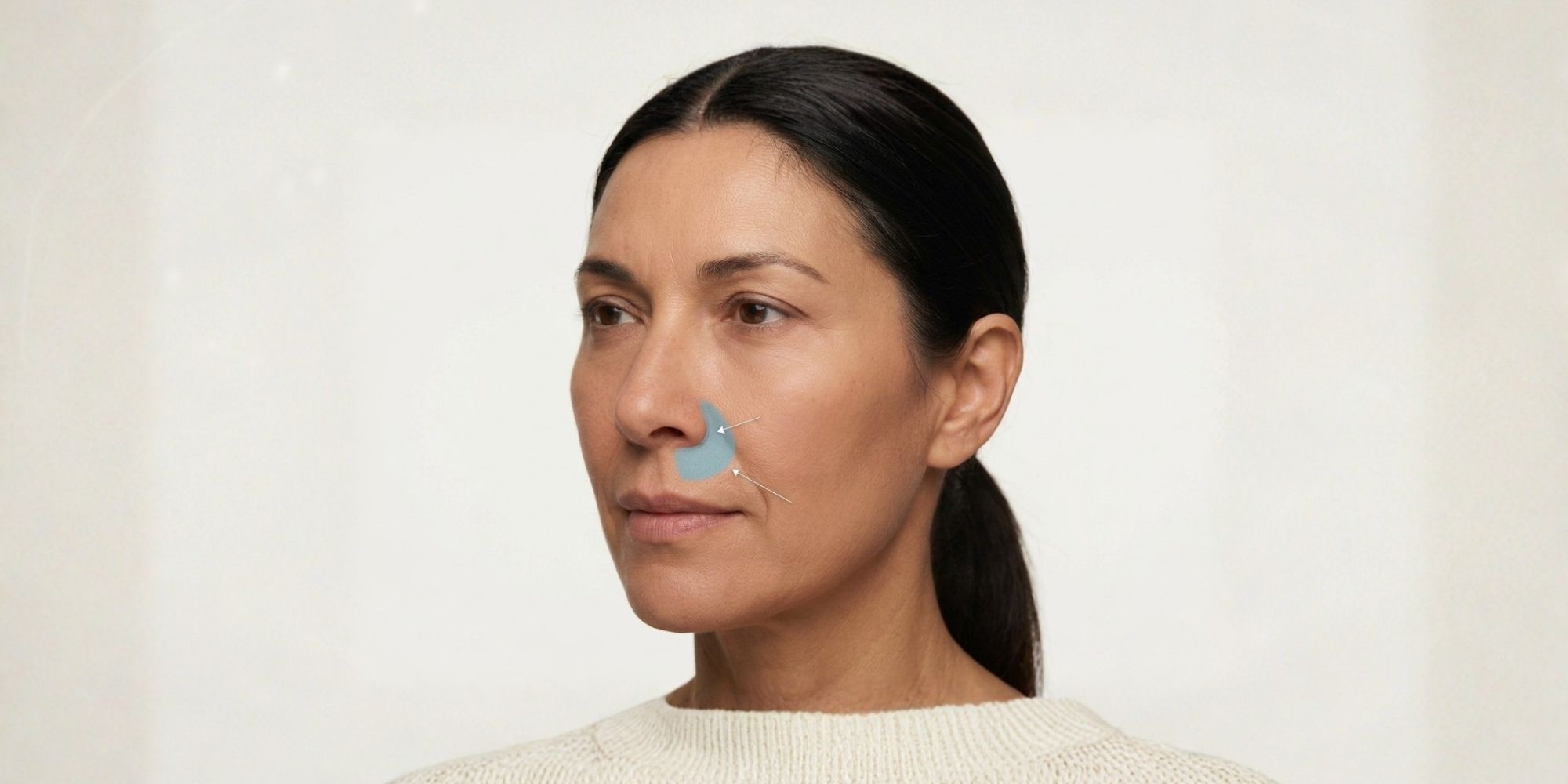 nasolabial-fold-fillers-Pyriform-Aperture-Area