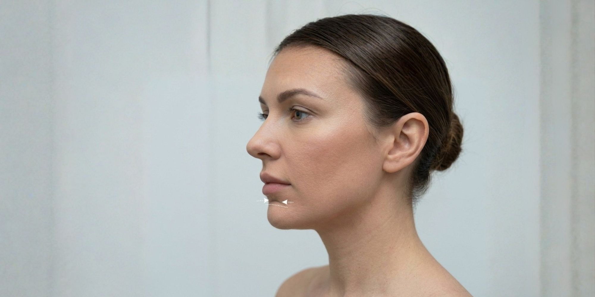 chin-filler-Mental-Crease