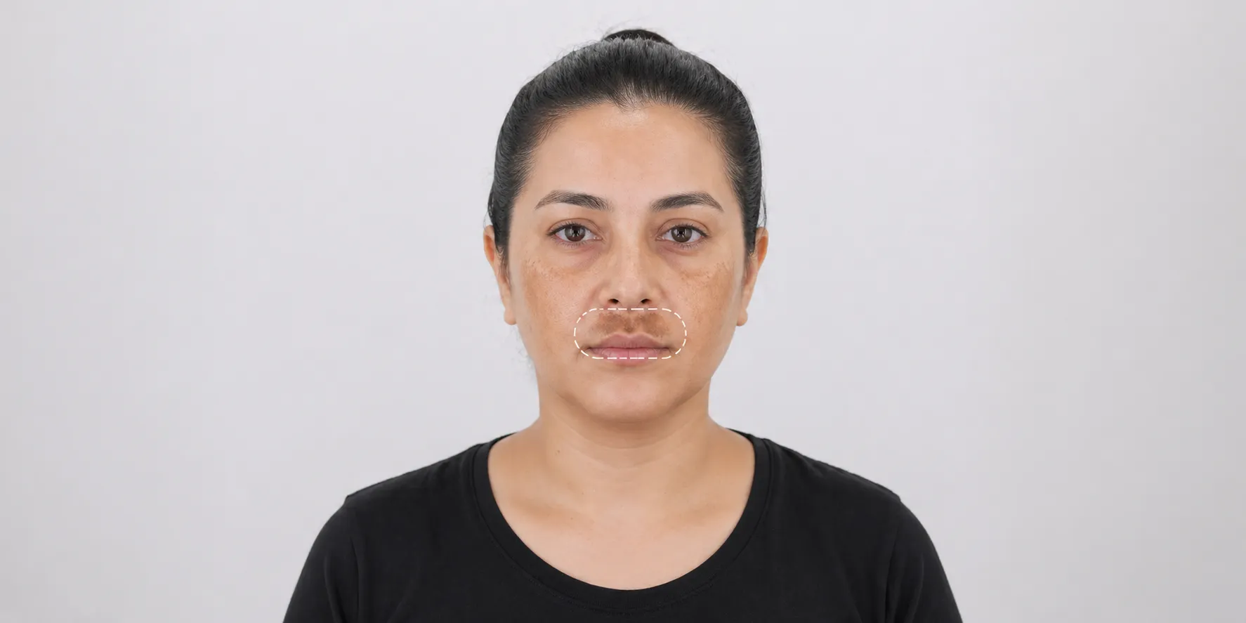 pico-laser-upper-lip