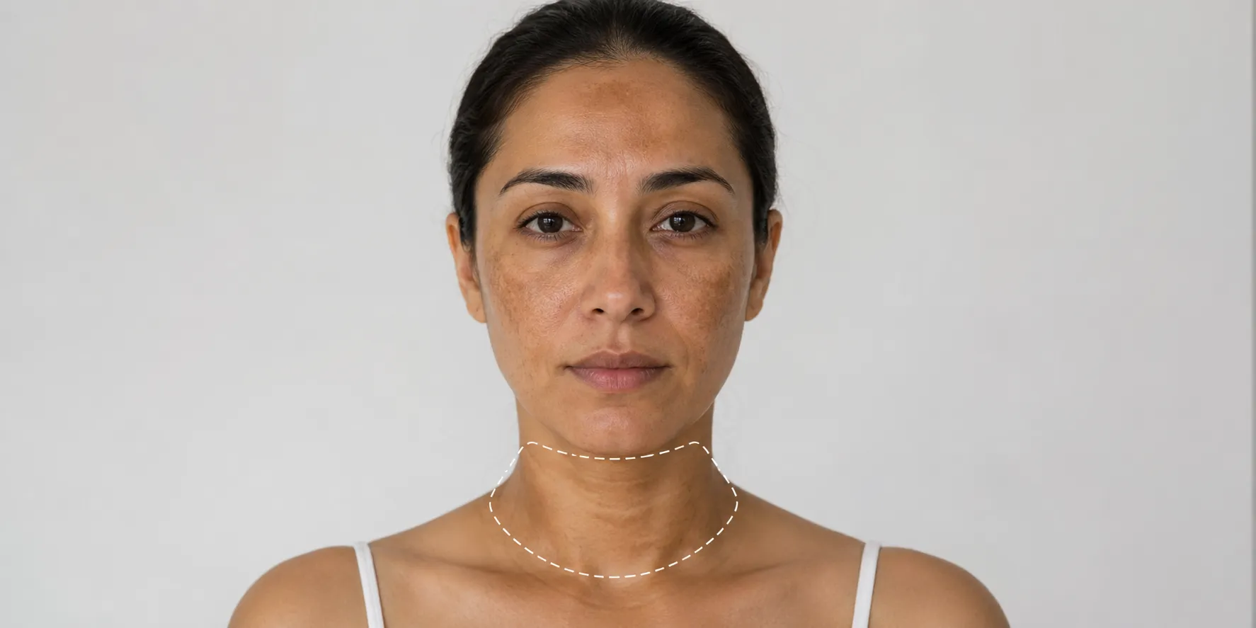 pico-laser-neck