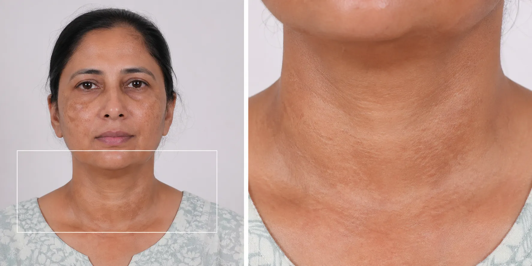 melasma-Neck-Area