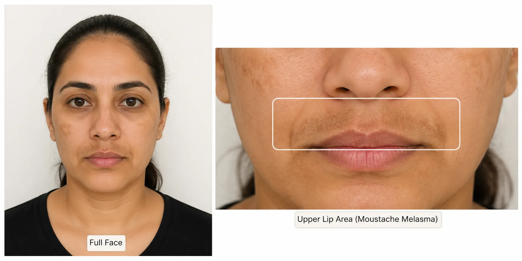 melasma-Upper-Lip-Area