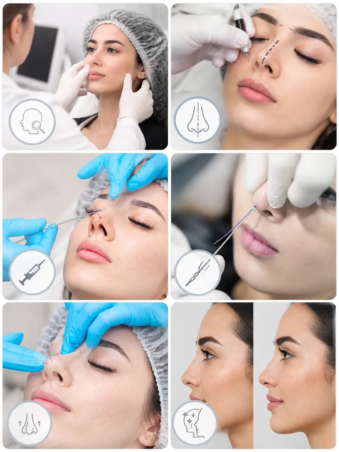 كيف تعمل تقنية شد الأنف بالخيوط (Nose thread lift Dubai)؟